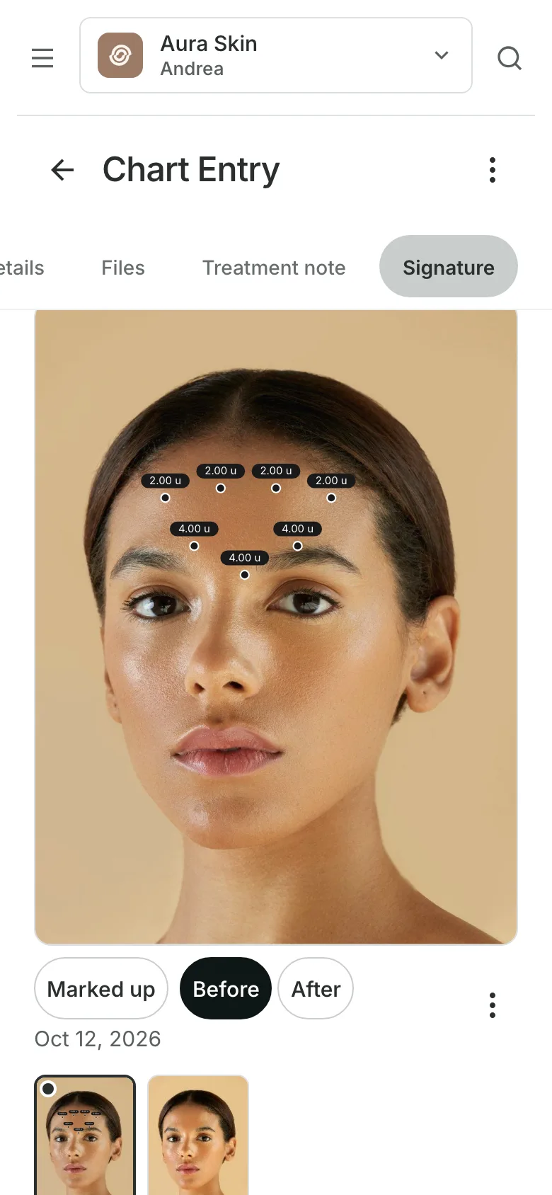 A signed chart entry on a phone: a photo of a face marked with injection points and their units, with the before and after photos under it