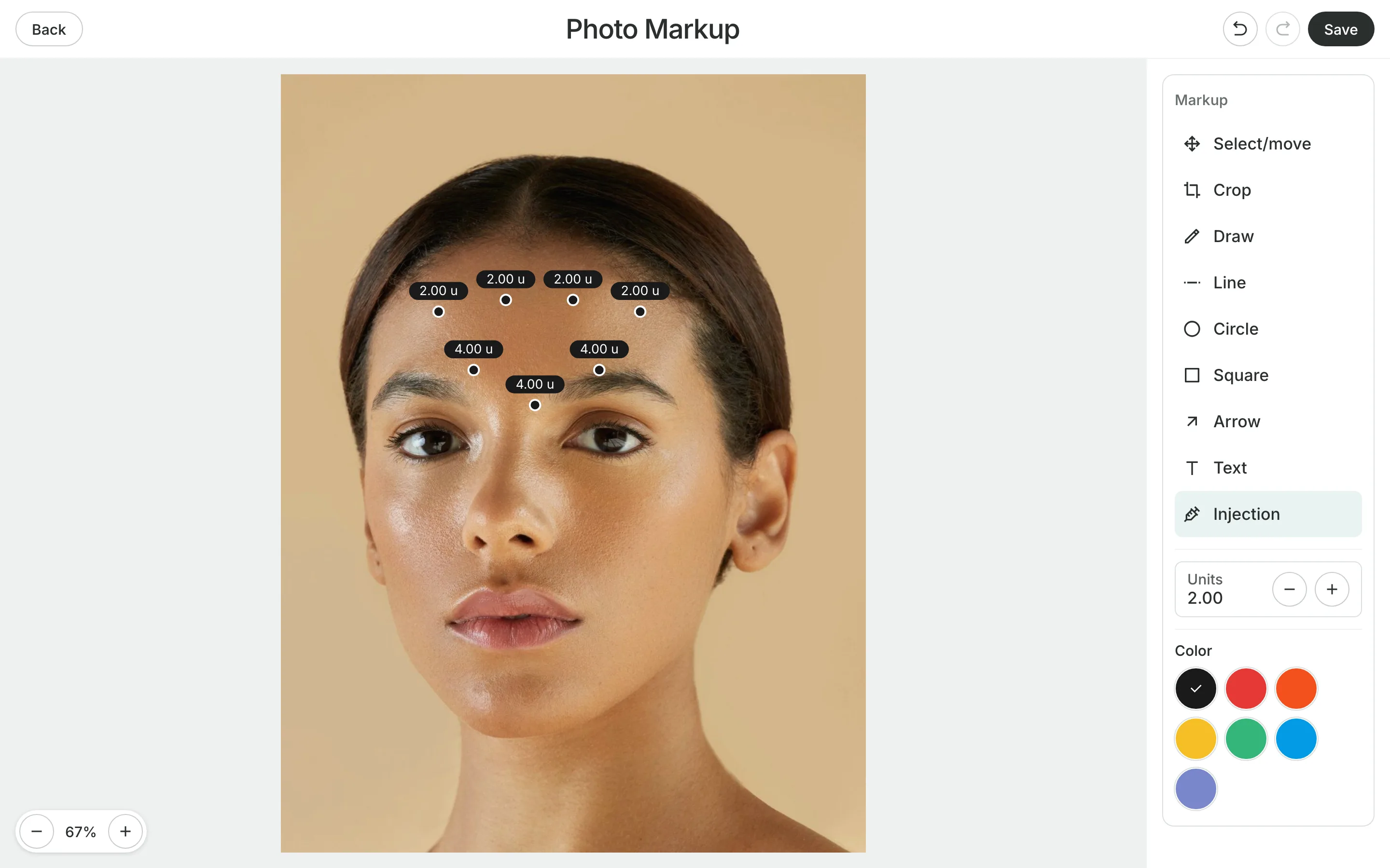 Photo Markup: a photo of a face with injection points on the forehead and between the brows, each labeled with its units, beside the drawing tools